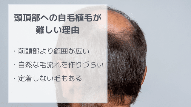 頭頂部への自毛植毛が難しいとされる理由３つ