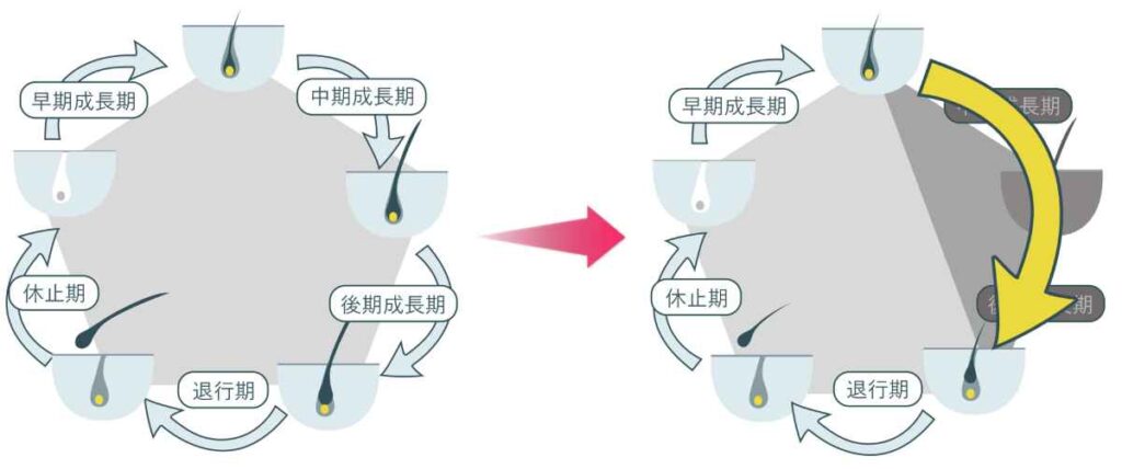 なぜジヒドロテストステロン(DHT)は「M字」や「つむじはげ」など薄毛（AGA）の原因になるの？