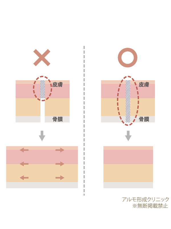 骨膜固定のイメージ
