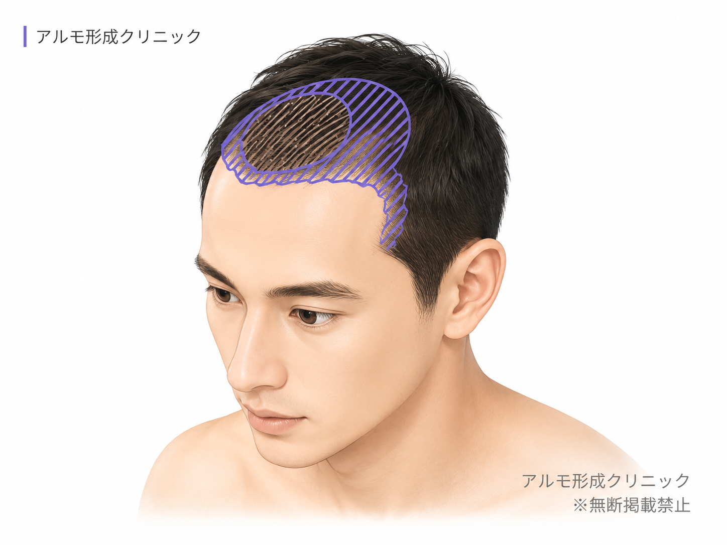 前頭部 1500G / Hi-STANDARD法