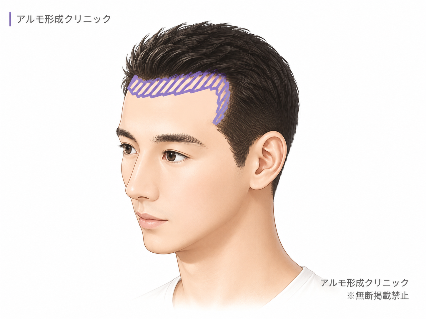 生え際+M字 1200G / Hi-STANDARD法