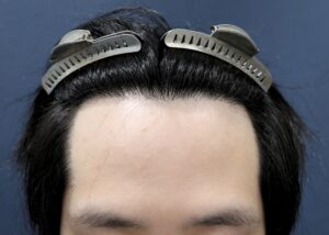 【2回目】術後1年