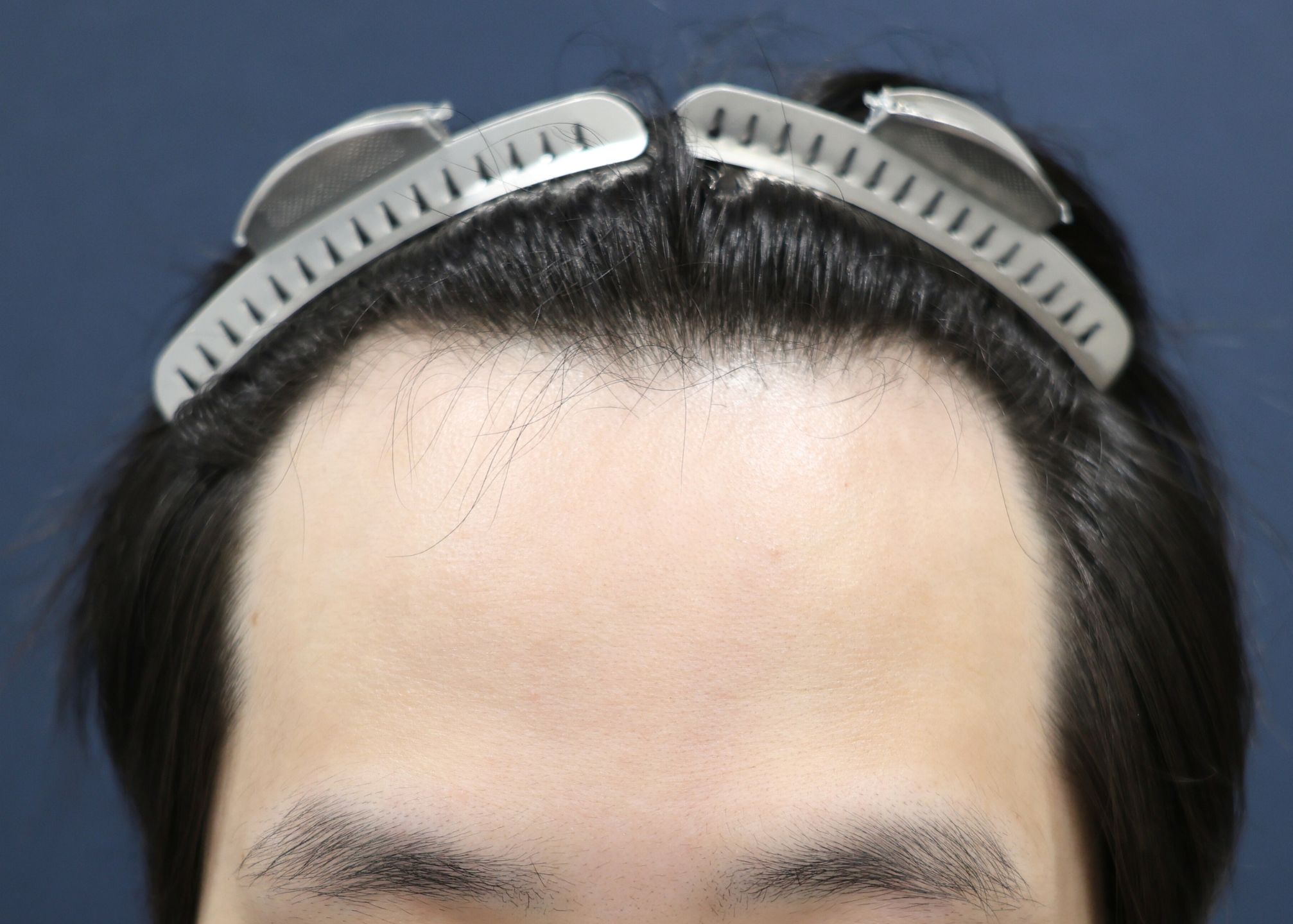 【1回目】施術前