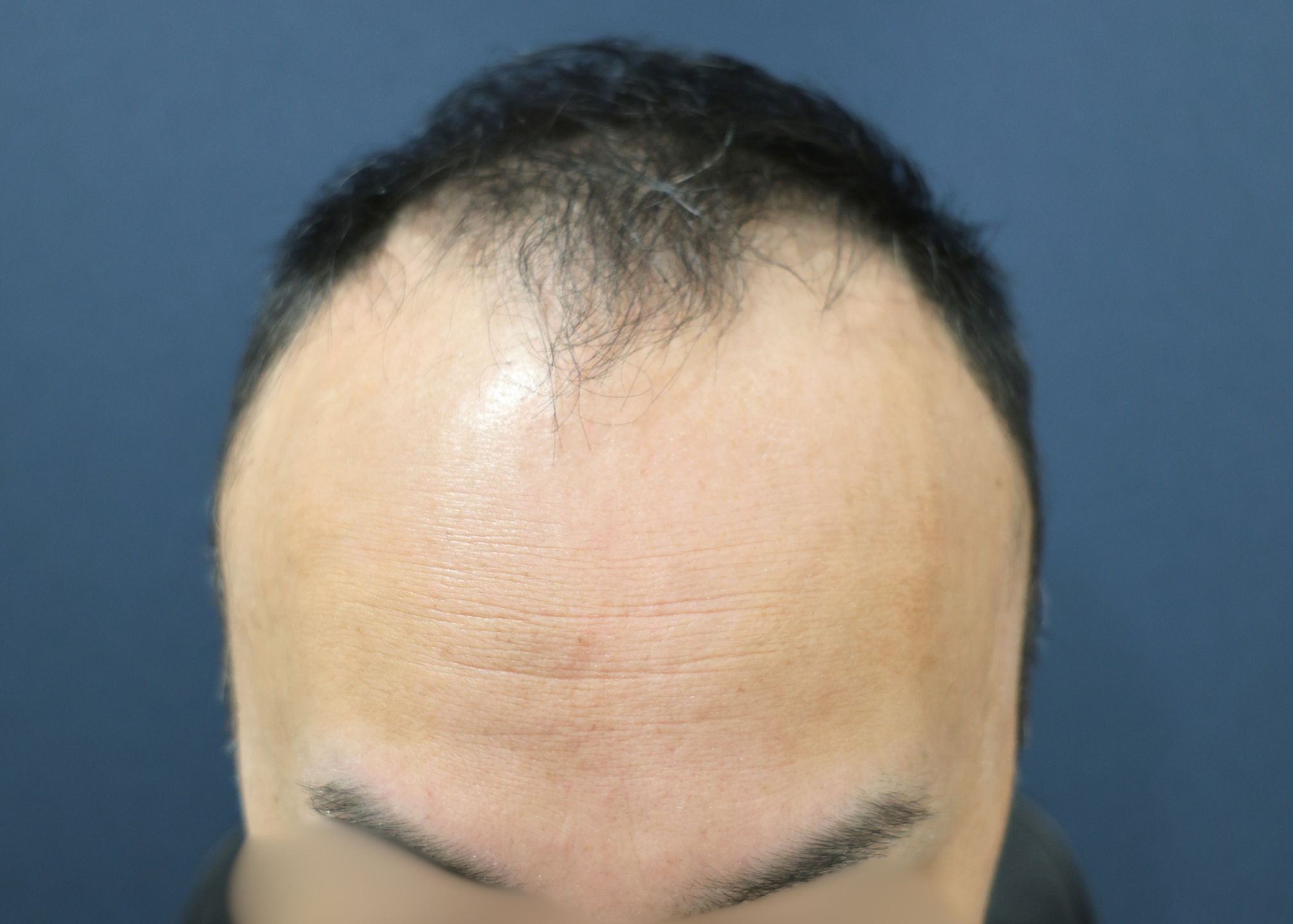 【1回目】施術前