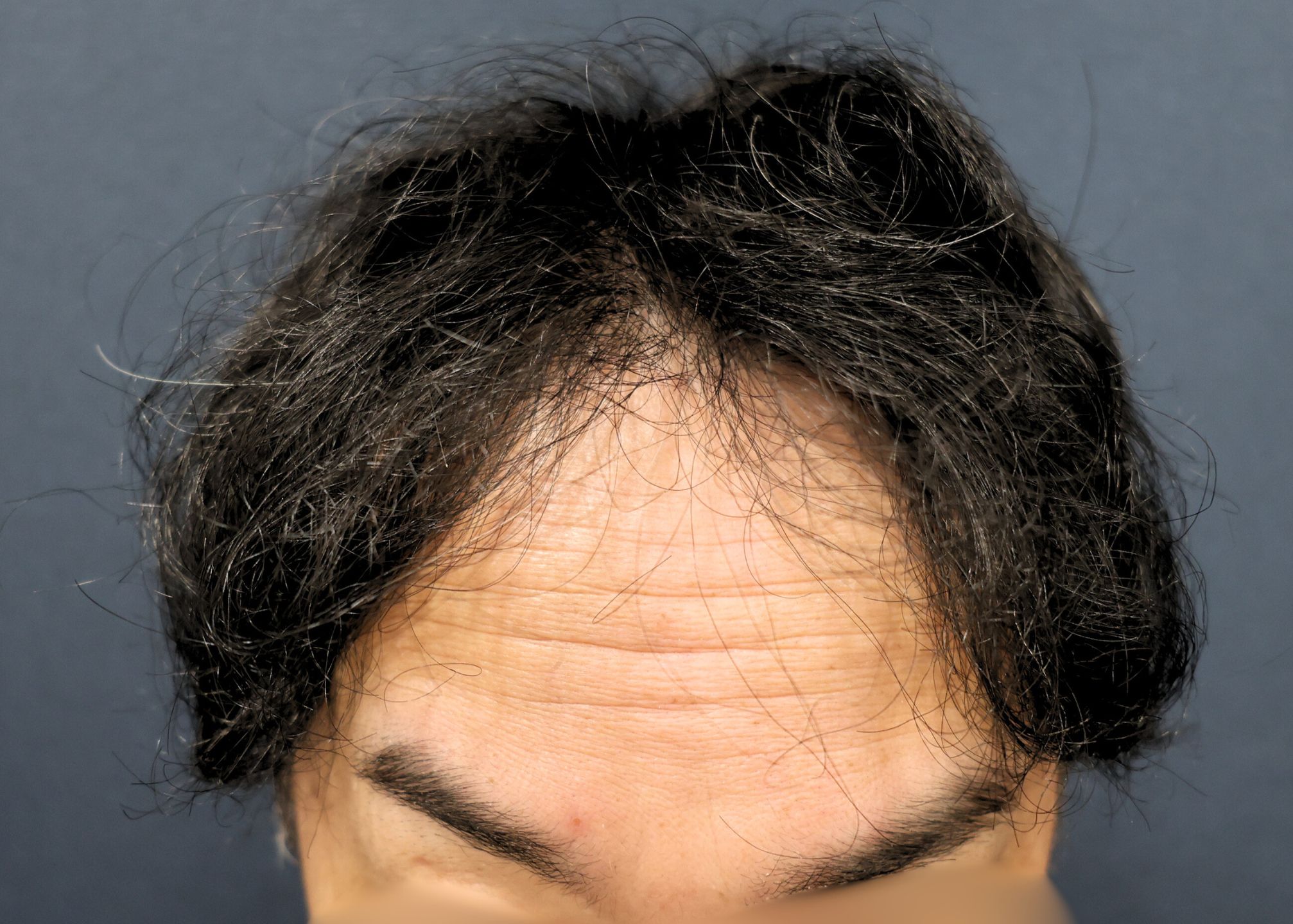 【2回目】施術後12ヶ月