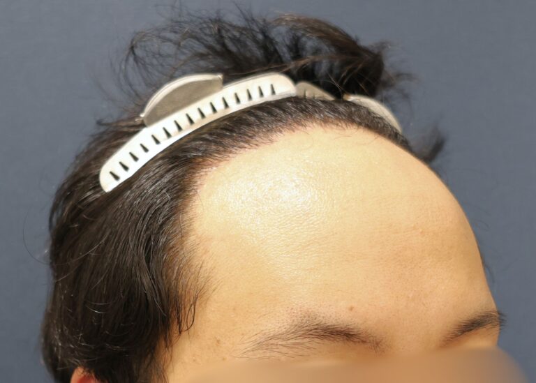 症例写真