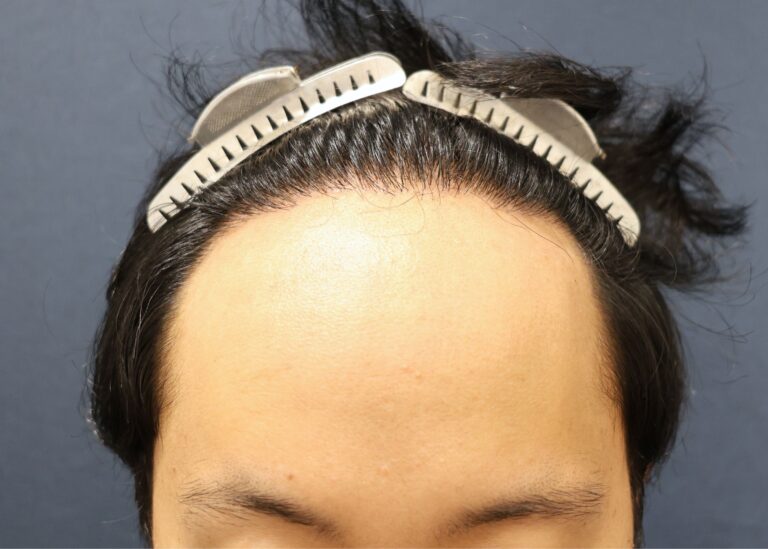 症例写真