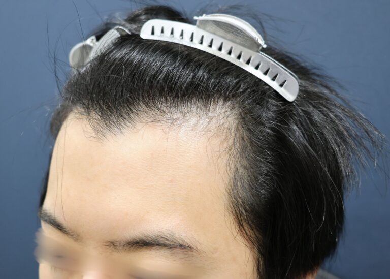 症例写真