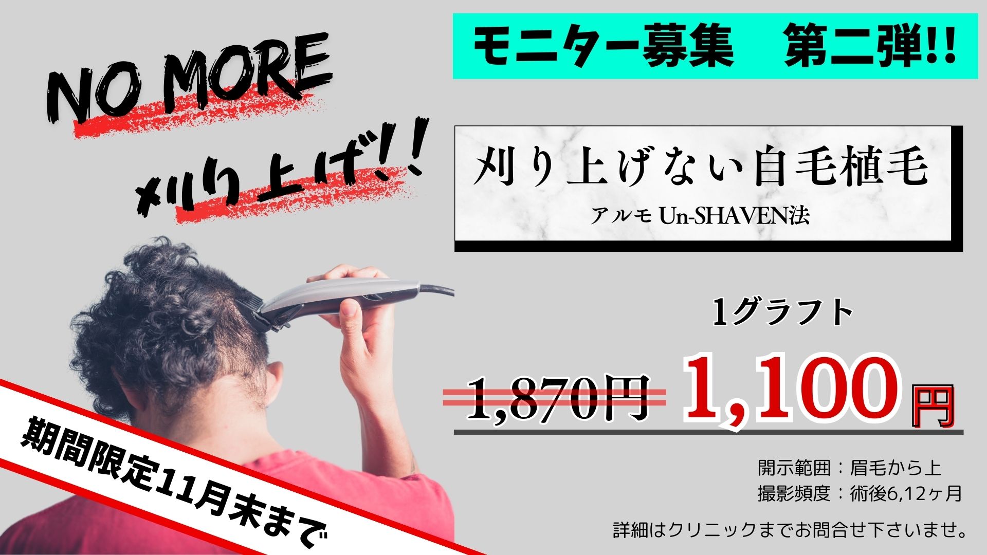 「刈り上げない自毛植毛 モニター募集 第二弾!! 」のお知らせ｜東京 自毛植毛 アルモ形成クリニック 美容外科