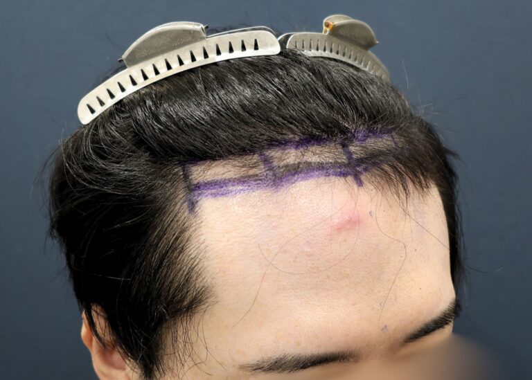 症例写真
