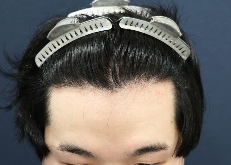症例写真