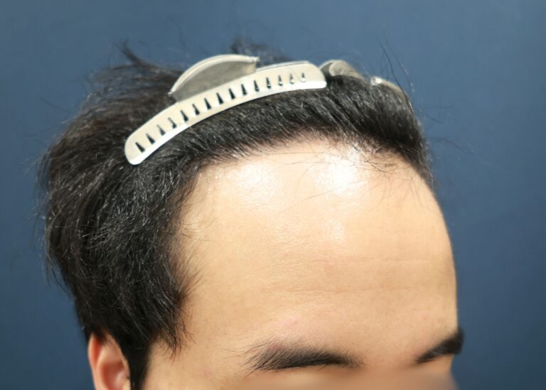 症例写真