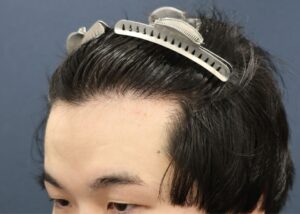 施術後15ヶ月