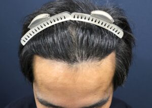 【2回目】術後6ヶ月