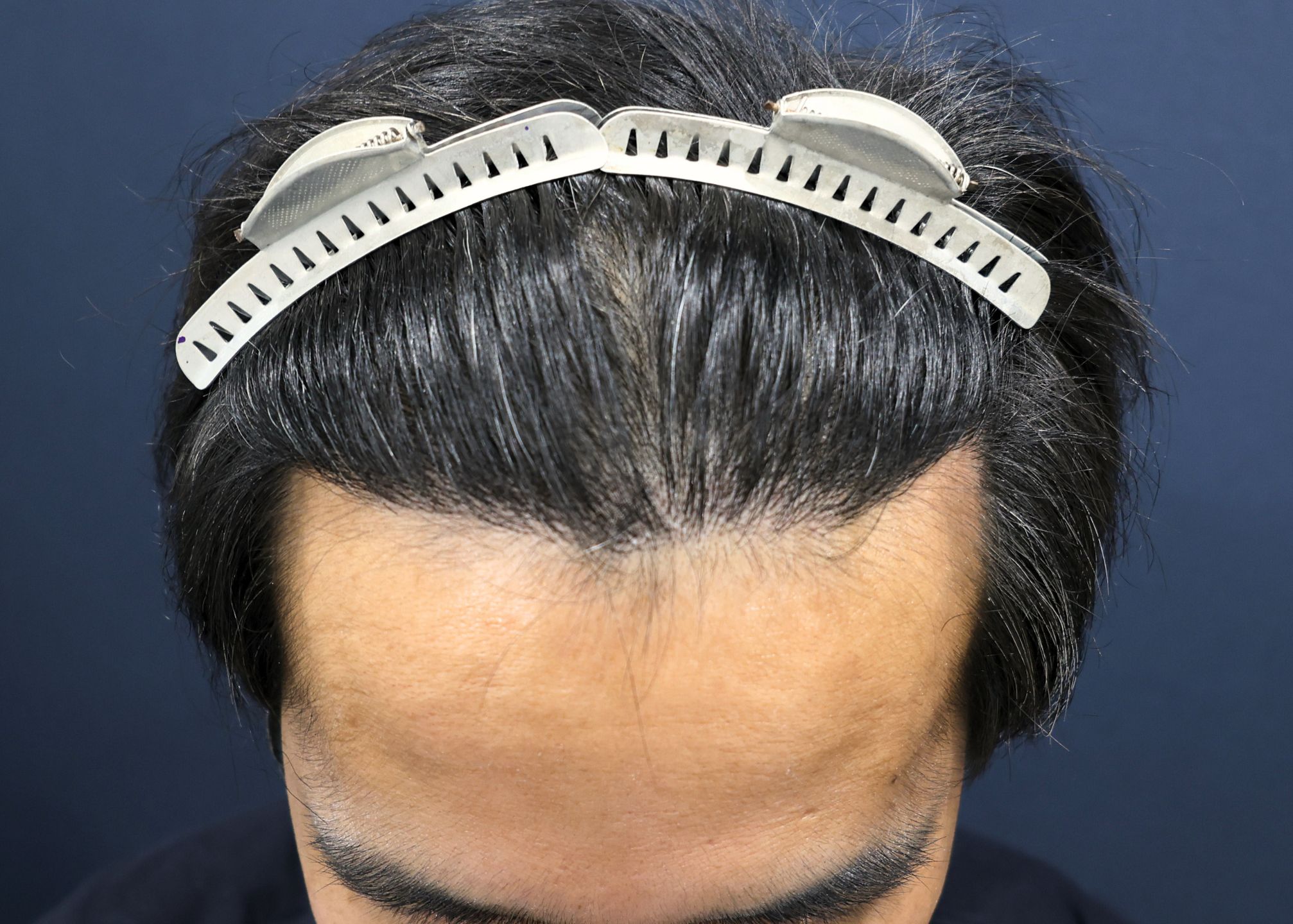 【2回目】術後6ヶ月