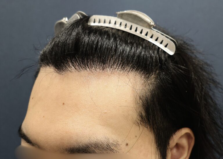 症例写真