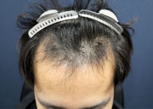 【1回目】施術前