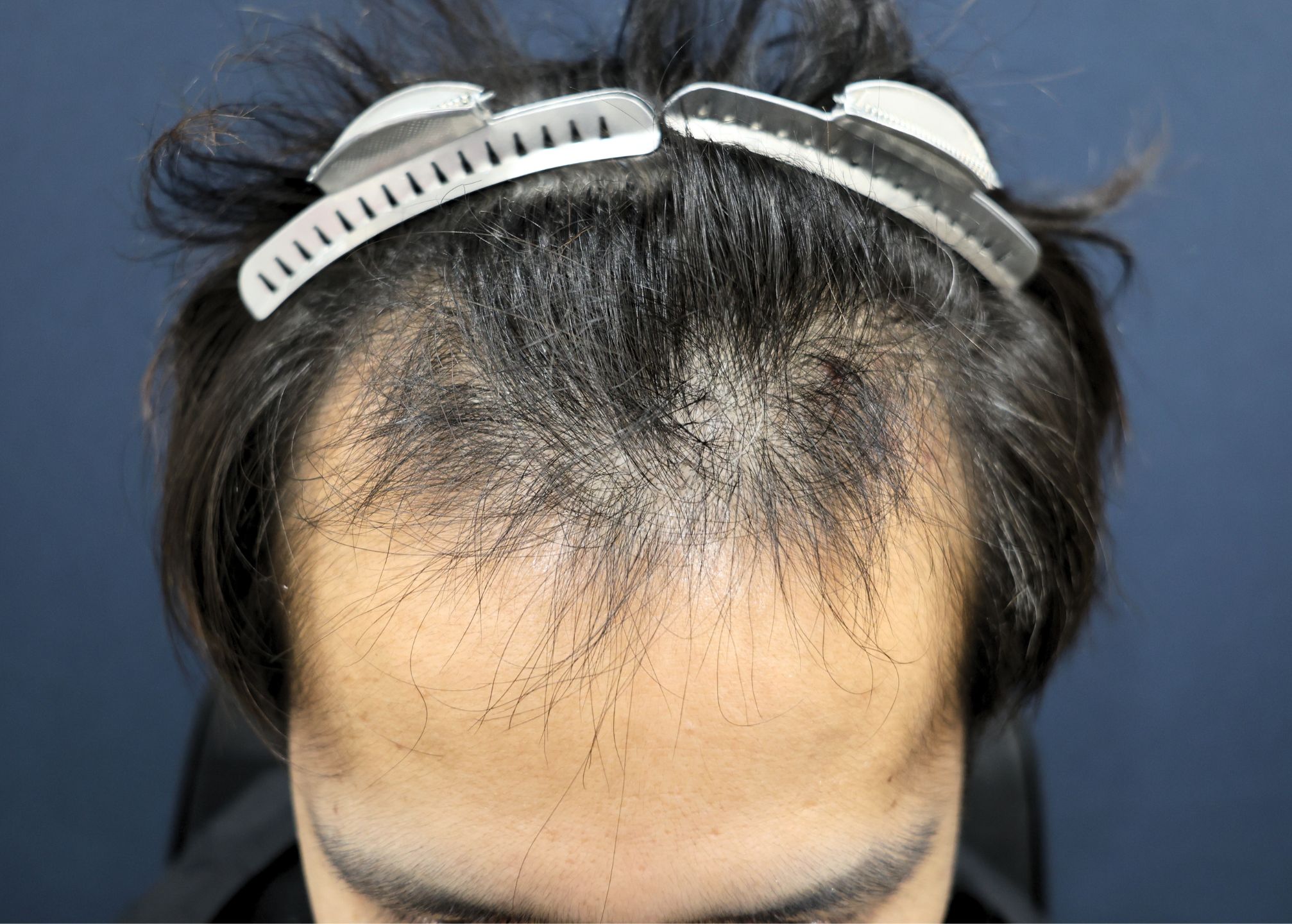 【1回目】施術前