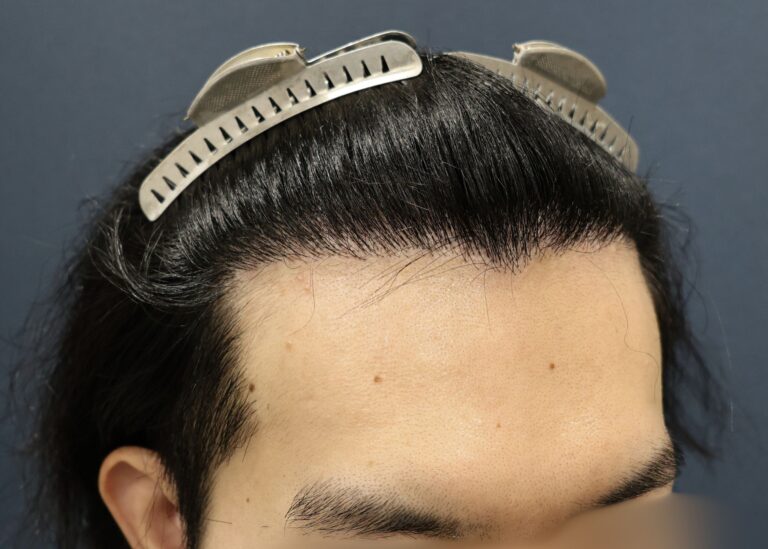 症例写真