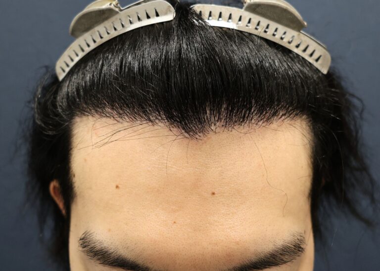 症例写真