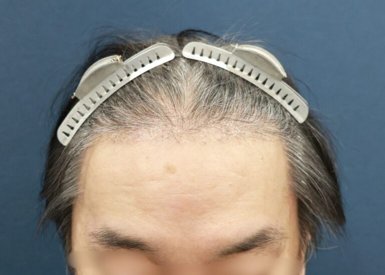 症例写真