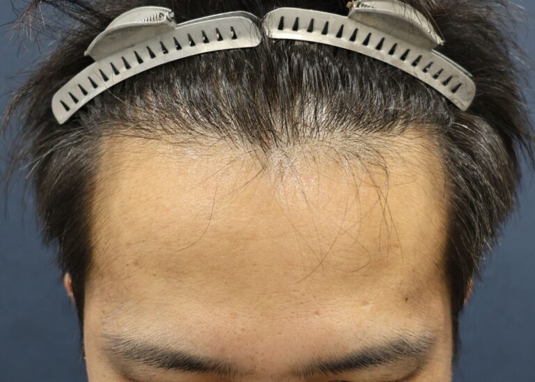 症例写真