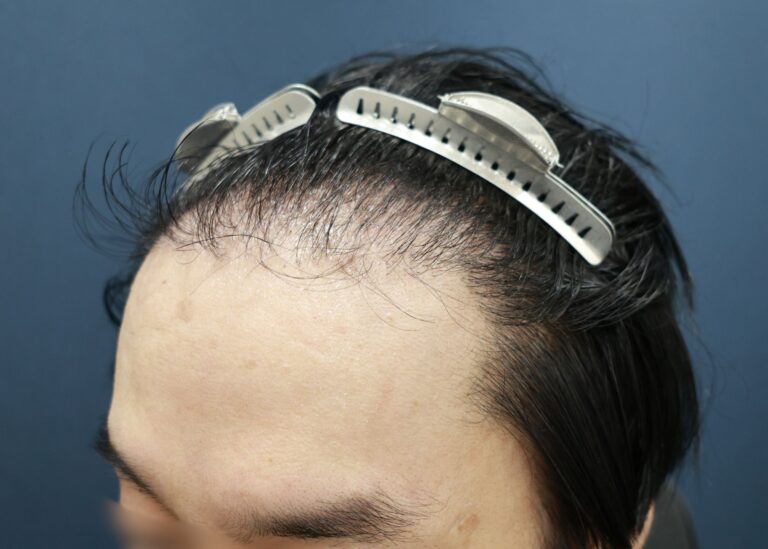 症例写真