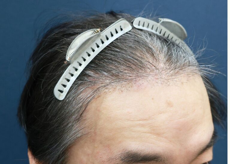 症例写真