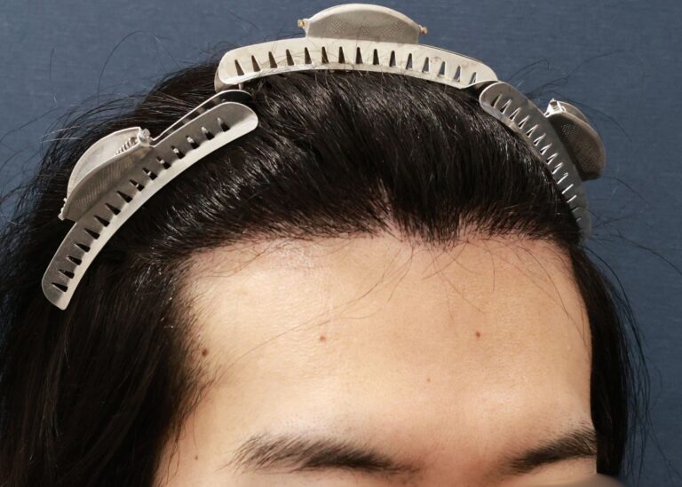 症例写真
