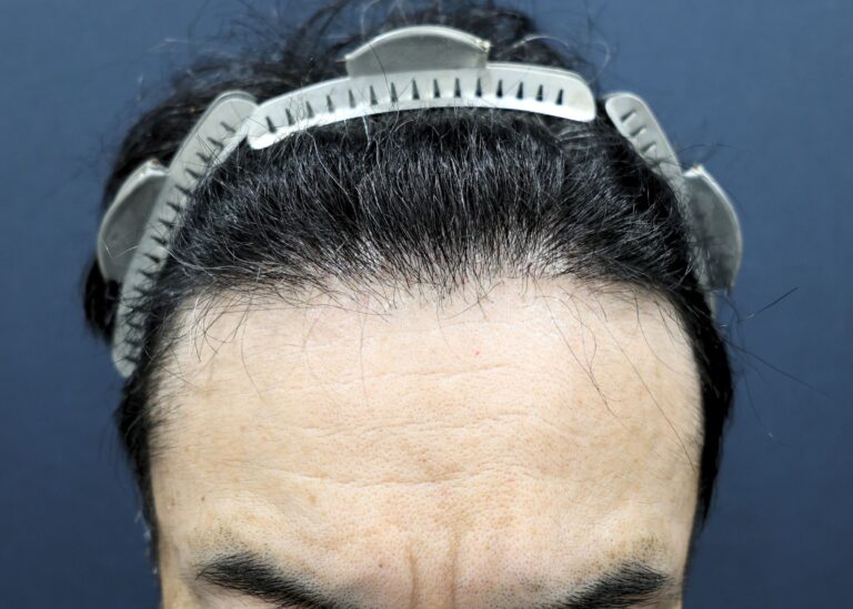 症例写真