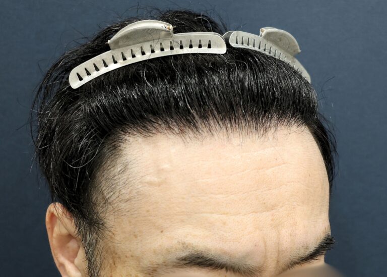 症例写真