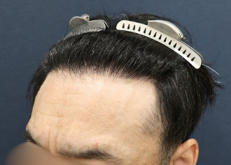 症例写真