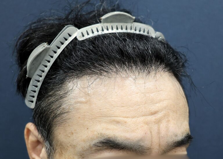 症例写真