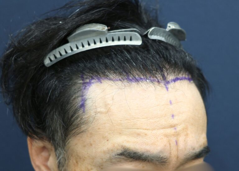 症例写真