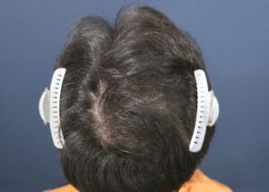 施術後9ヶ月