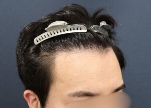 施術後9ヶ月