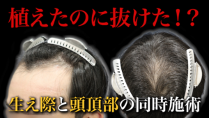 【30代薄毛】生え際と頭頂部に植毛して1年経過。ショックロスを最低限に抑えるためには...。