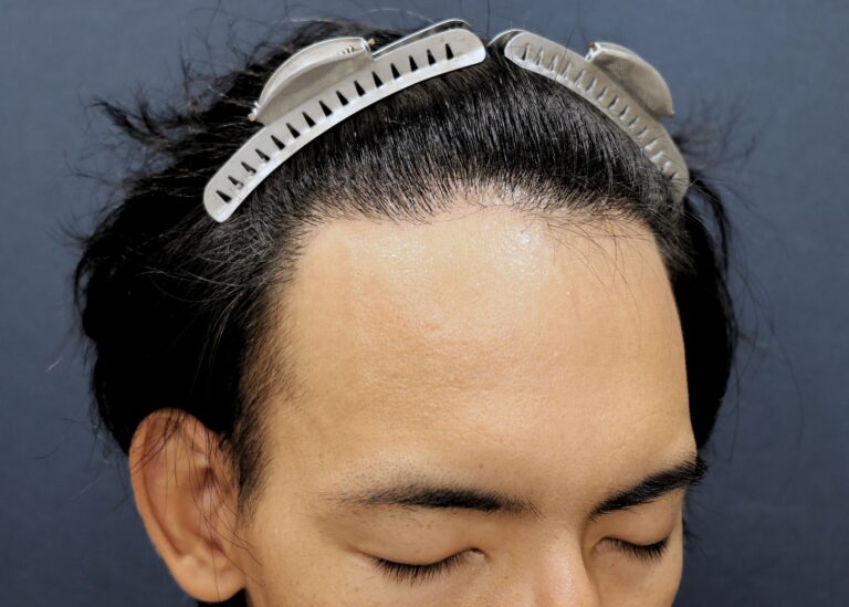 症例写真