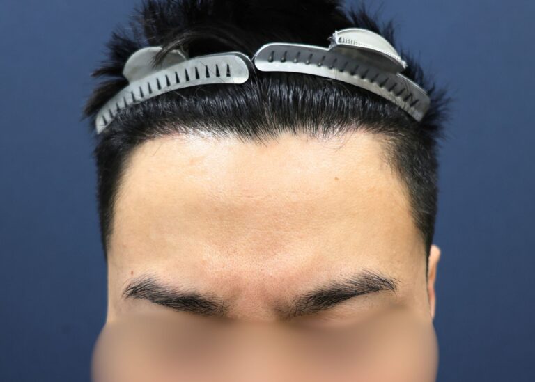 症例写真