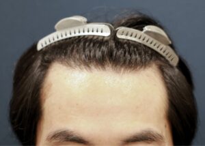 【1回目】施術前