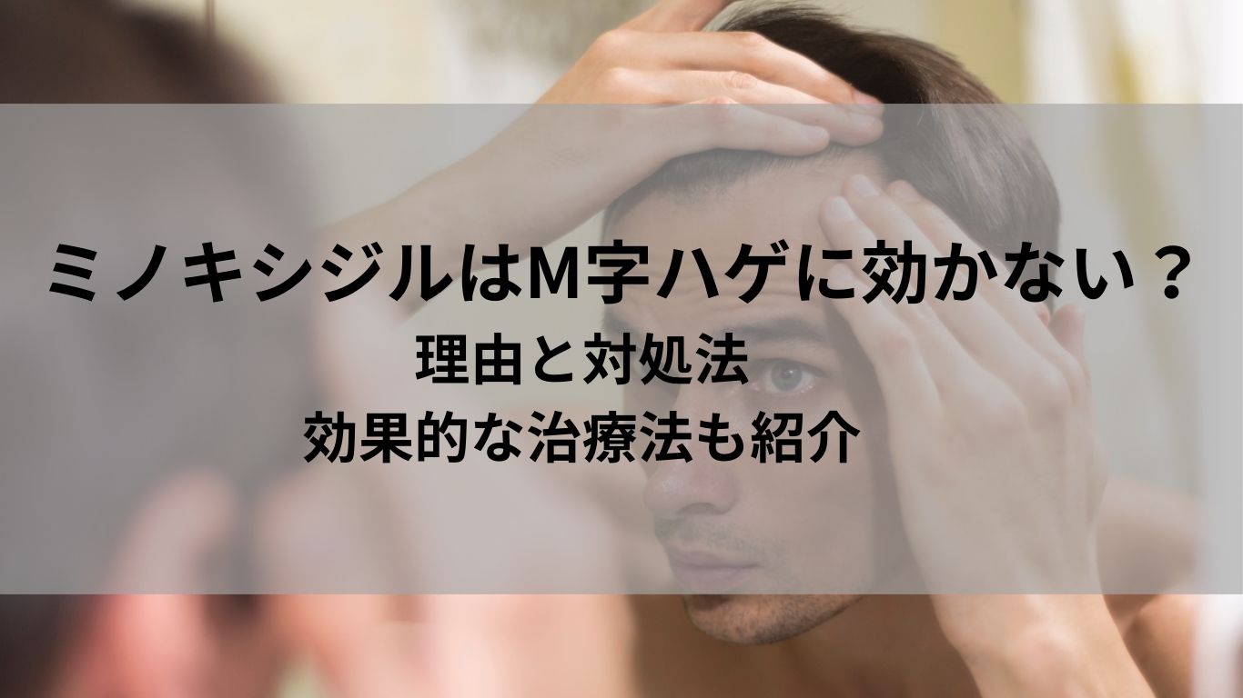 ミノキシジルはM字ハゲに効かない？理由と対処法｜効果的な治療法も紹介