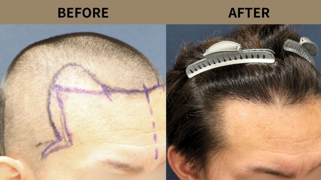 植毛は坊主だとバレる？傷跡が目立つ理由と目立たない術式で最善の対策を