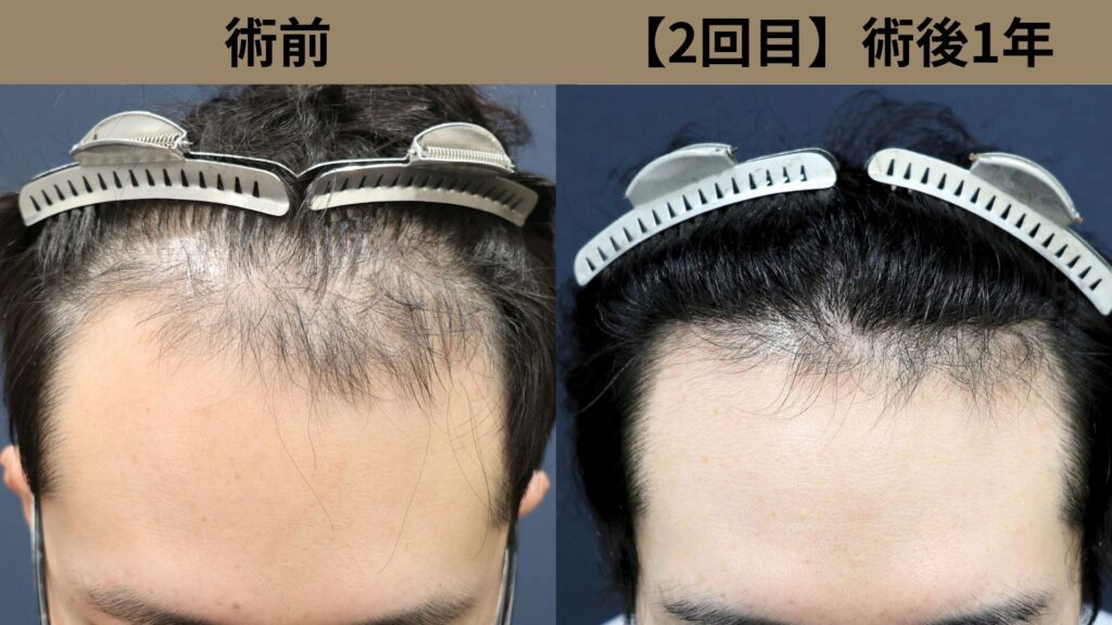 東京の額縮小術と自毛植毛で理想のヘアライン