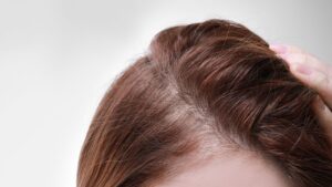 女性型脱毛症（FPHL）とは？｜原因・症状・治療法を専門医が詳しく解説