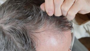 【医師監修】牽引性脱毛症とは?原因・症状・診断・治療・予防