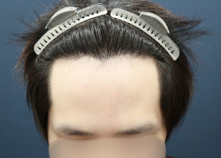 症例写真