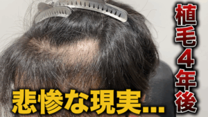 【絶望】植えたはずがスカスカに！？2回目の植毛6ヶ月後の結果は...