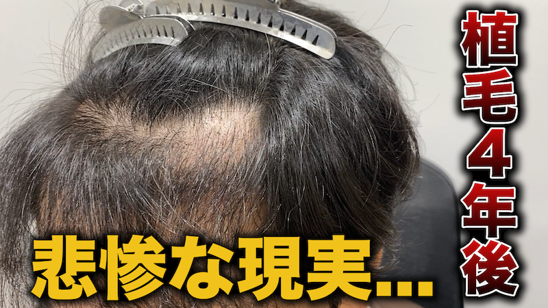 【絶望】植えたはずがスカスカに！？2回目の植毛6ヶ月後の結果は...