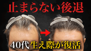 【40代のリアル】自毛植毛6ヶ月後、生え際がここまで変わる！年相応なデザインとは？