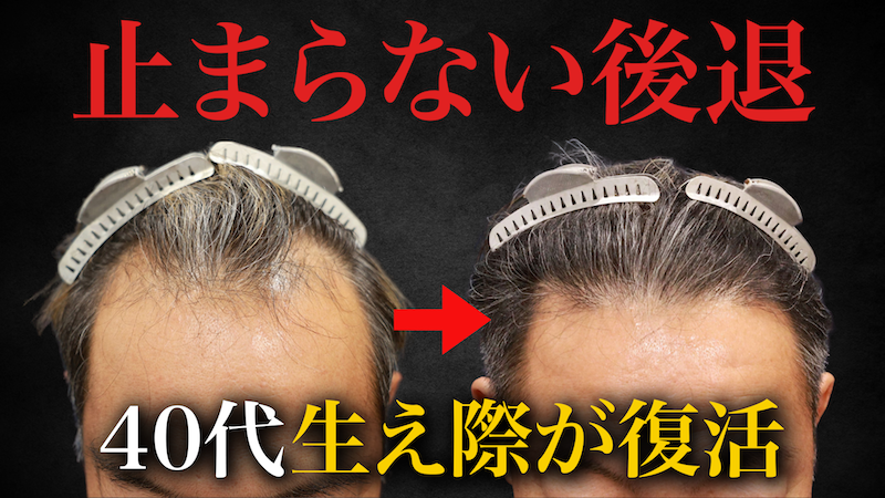 【40代のリアル】自毛植毛6ヶ月後、生え際がここまで変わる！年相応なデザインとは？
